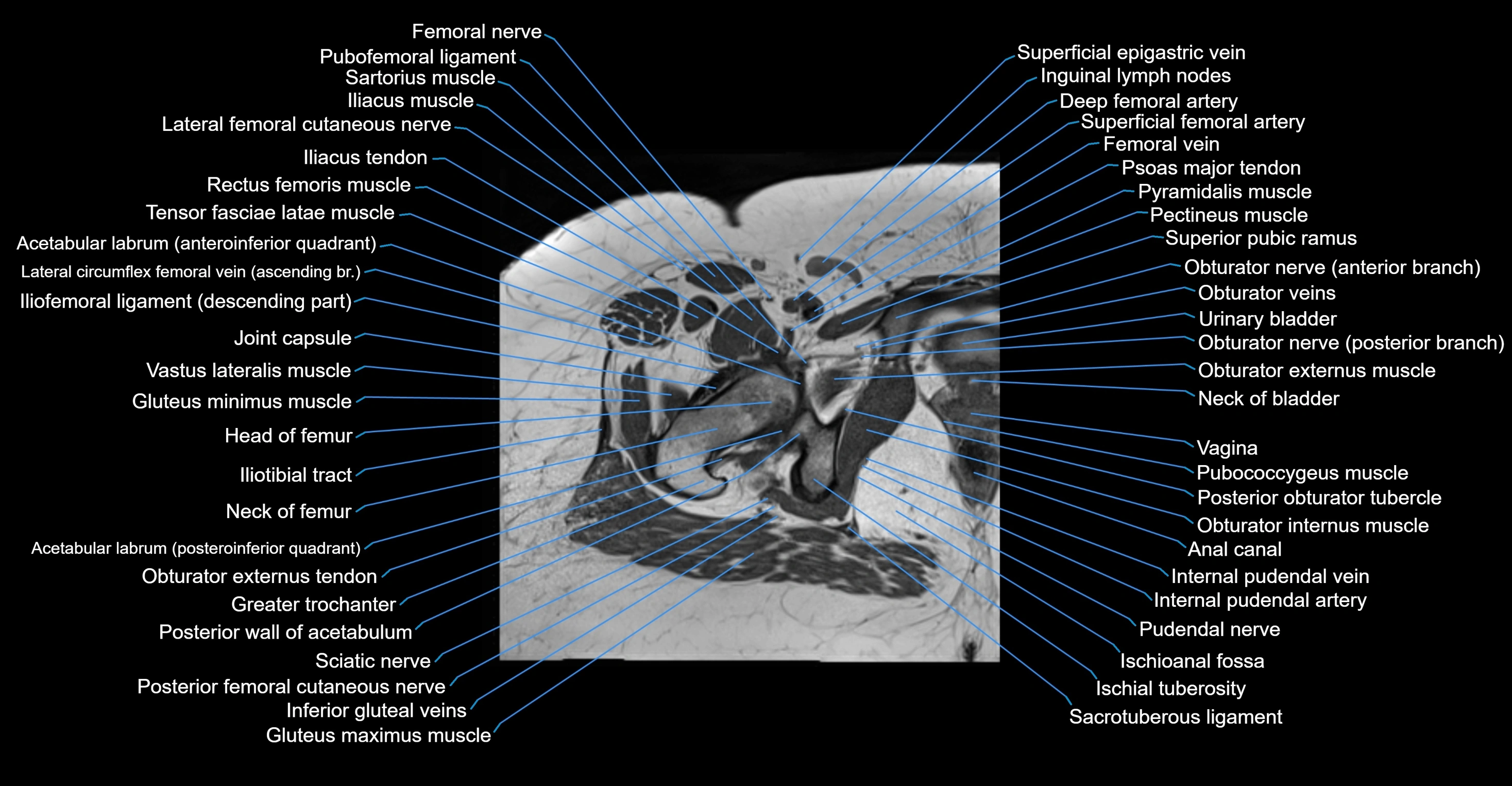 MRI hip axial cross sectional anatomy 3T 3D  radiology  anatomy image-img-00001-00047.webp